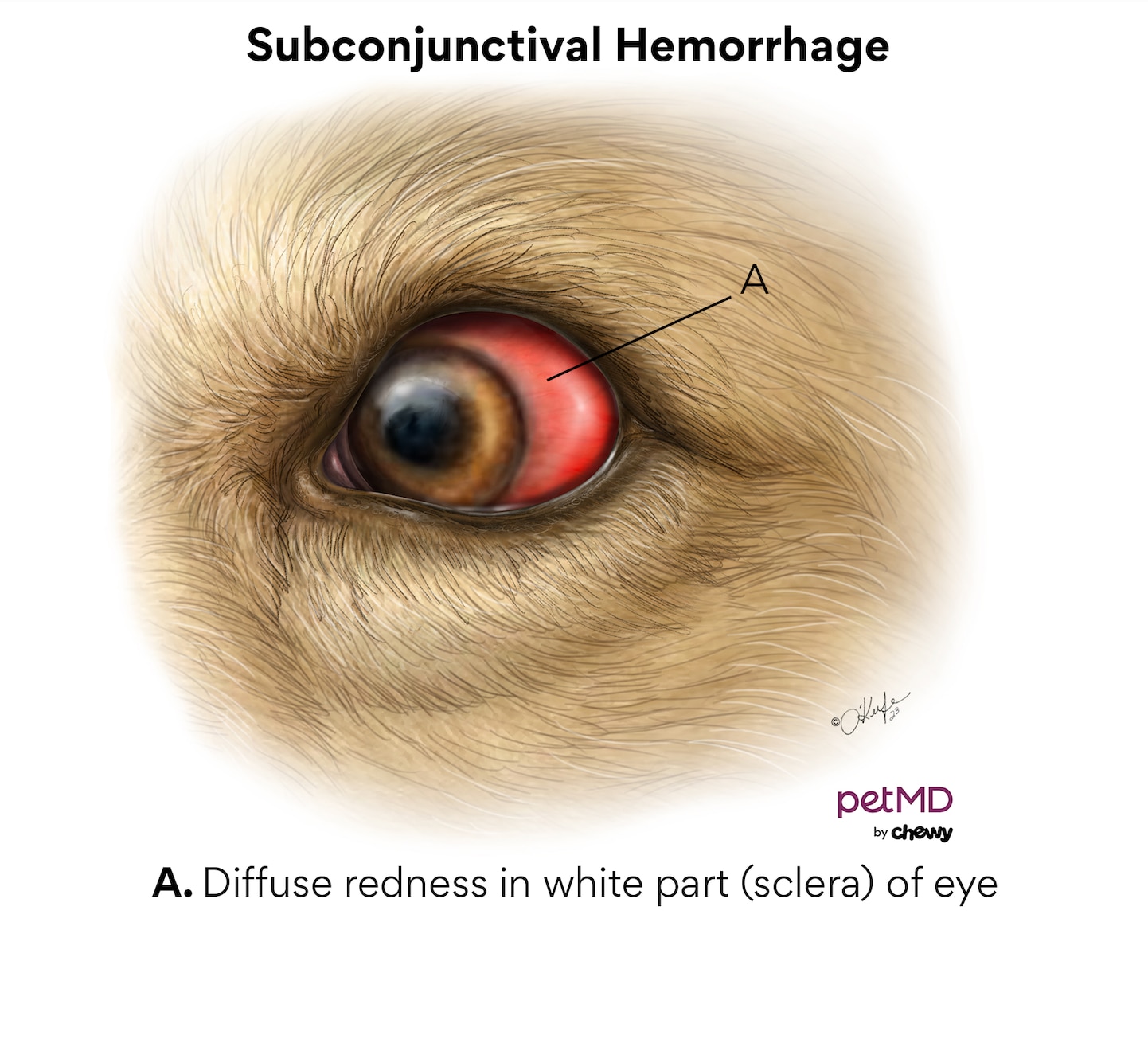 Subconjunctival hemorrhage